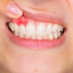 Natural Plant Compound Shows Promise for Treating Gum Disease