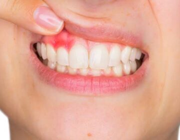 Natural Plant Compound Shows Promise for Treating Gum Disease