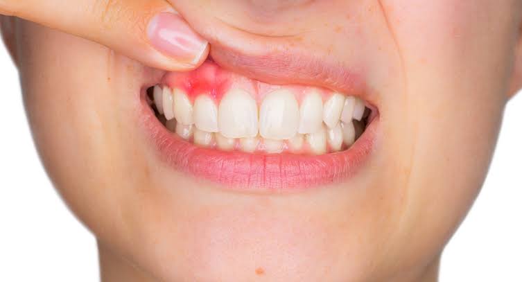 Natural Plant Compound Shows Promise for Treating Gum Disease