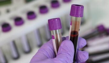 Blood Test Detects Head and Neck Cancer up to 10 Years Before Symptoms