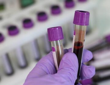 Blood Test Detects Head and Neck Cancer up to 10 Years Before Symptoms