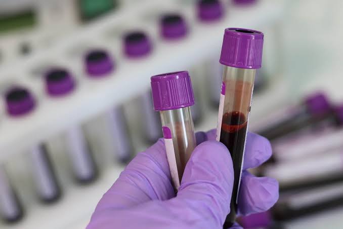 Blood Test Detects Head and Neck Cancer up to 10 Years Before Symptoms