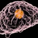 Two Cheap Supplements Show Promise in Healing One of the Deadliest Brain Cancers