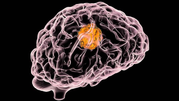 Two Cheap Supplements Show Promise in Healing One of the Deadliest Brain Cancers