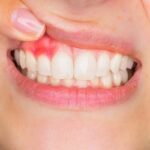 Poor Oral Health Linked to Hidden Brain Damage