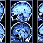 New Brain Signal Predicts Alzheimer’s Years Before Diagnosis