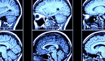 New Brain Signal Predicts Alzheimer’s Years Before Diagnosis