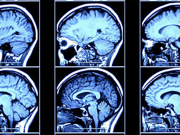 New Brain Signal Predicts Alzheimer’s Years Before Diagnosis