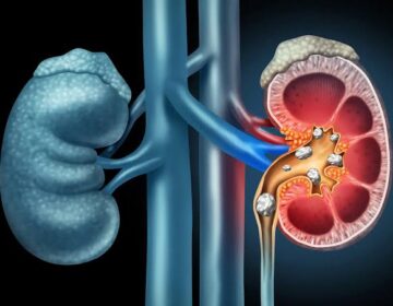 Scientists Discover Living Bacteria Hidden Inside the 1 Type of Kidney Stone
