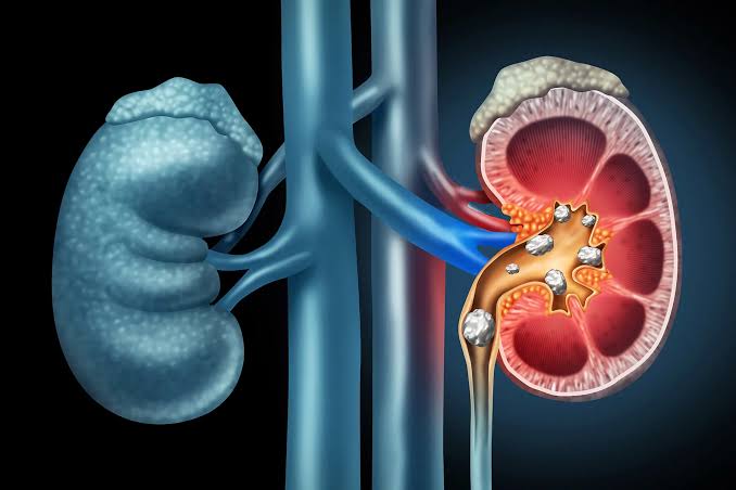 Scientists Discover Living Bacteria Hidden Inside the 1 Type of Kidney Stone