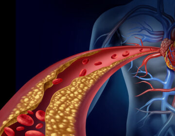 High cholesterol may predict future heart disease risk, even in healthy women