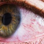 Common Bacteria Found in the Eye Linked to Alzheimer’s Disease