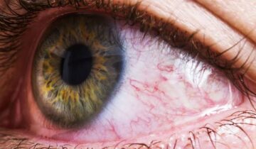 Common Bacteria Found in the Eye Linked to Alzheimer’s Disease