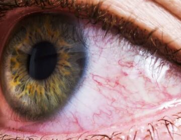 Common Bacteria Found in the Eye Linked to Alzheimer’s Disease