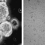 Can a Common Vitamin Fight the Most Aggressive Brain Cancer?