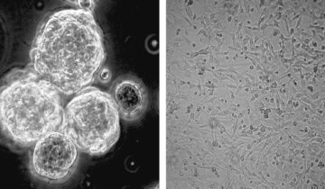 Can a Common Vitamin Fight the Most Aggressive Brain Cancer?