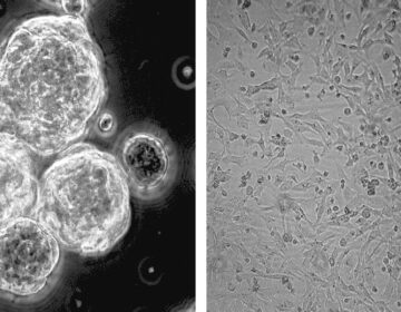 Can a Common Vitamin Fight the Most Aggressive Brain Cancer?