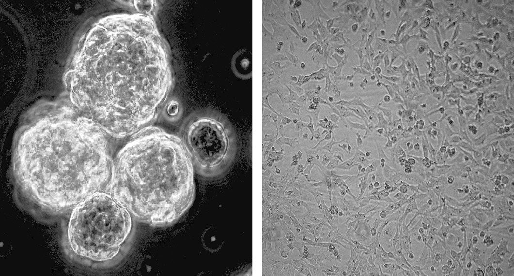 Can a Common Vitamin Fight the Most Aggressive Brain Cancer?