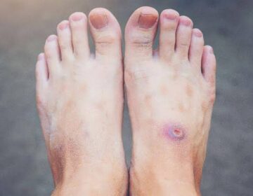 Why Diabetic Wounds Refuse To Heal