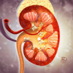 Why Drinking More Water Isn’t Enough To Stop Kidney Stones