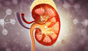 Why Drinking More Water Isn’t Enough To Stop Kidney Stones