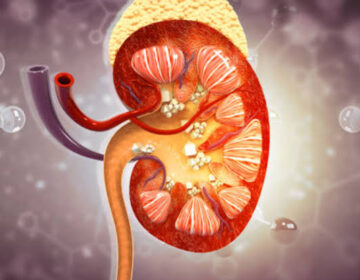 Why Drinking More Water Isn’t Enough To Stop Kidney Stones