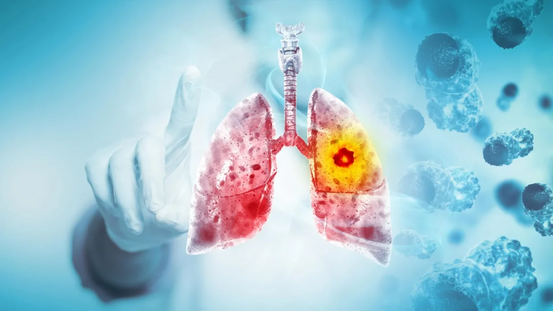 Scientists Discover Way To Treat Lung Cancer and Its Deadly Side Effect Together
