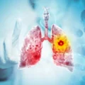 Scientists Discover Way To Treat Lung Cancer and Its Deadly Side Effect Together