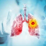 Scientists Discover Way To Treat Lung Cancer and Its Deadly Side Effect Together
