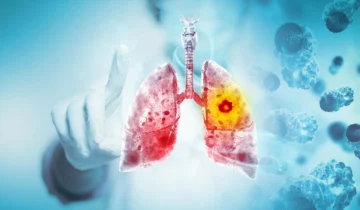 Scientists Discover Way To Treat Lung Cancer and Its Deadly Side Effect Together