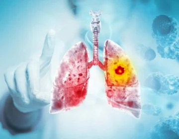 Scientists Discover Way To Treat Lung Cancer and Its Deadly Side Effect Together