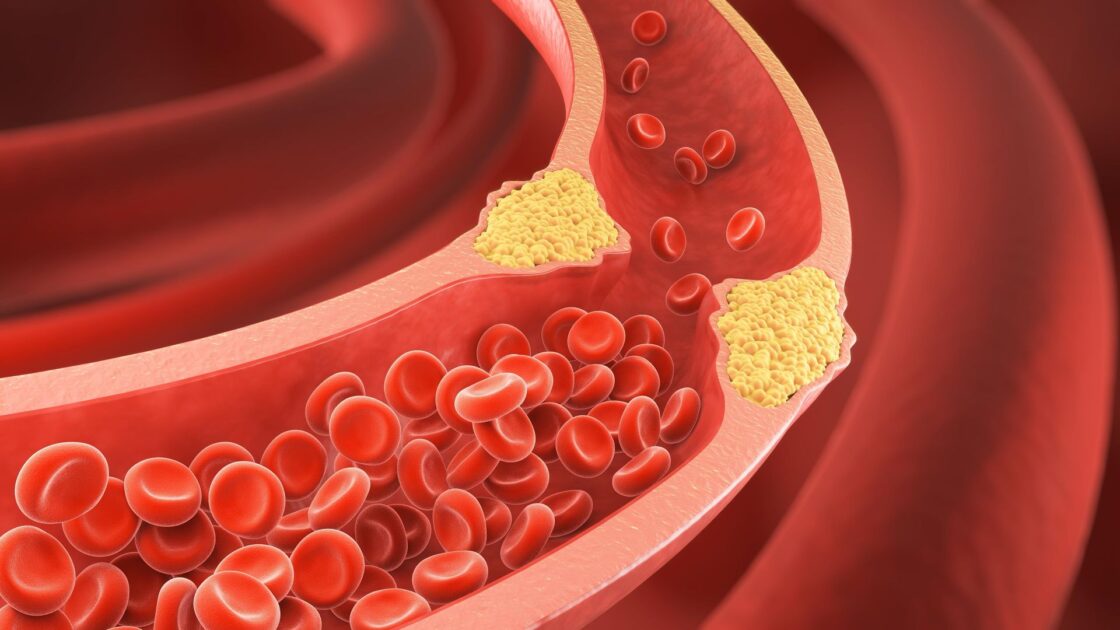 You May Have a Dangerous Type of Cholesterol Even if Your Tests Look Normal