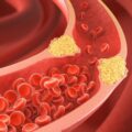 You May Have a Dangerous Type of Cholesterol Even if Your Tests Look Normal