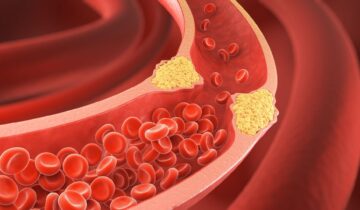 You May Have a Dangerous Type of Cholesterol Even if Your Tests Look Normal