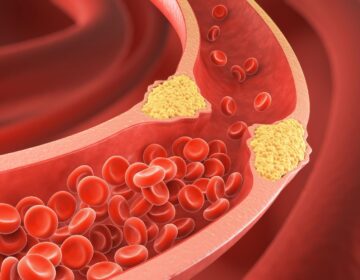 You May Have a Dangerous Type of Cholesterol Even if Your Tests Look Normal