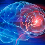 Scientists Reverse Stroke Damage Using Stem Cells in Breakthrough Study