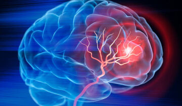 Scientists Reverse Stroke Damage Using Stem Cells in Breakthrough Study